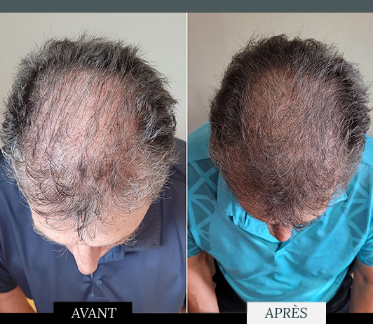 La micro pigmentation offre une alternative efficace contre la calvitie : résultat immédiat, densité adaptée et apparence naturelle sans chirurgie, durable plusieurs années