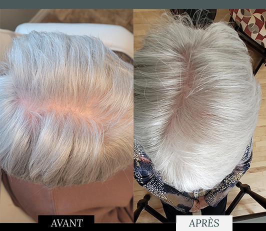 La micro pigmentation pour cheveux gris offre une solution personnalisée, intégrant discrètement la teinte grise pour un résultat naturel et durable 5 à 10 ans