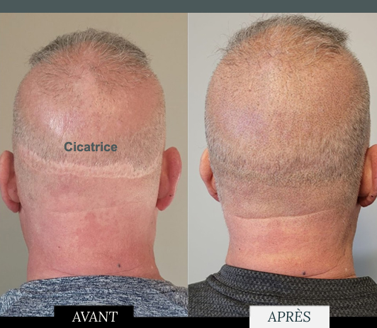 micropigmentationcapillaire-cicatrice-arriere-tete