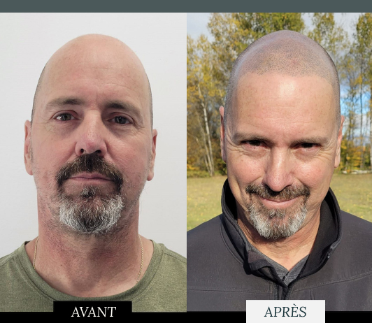 La micro pigmentation combat la calvitie avec une solution non chirurgicale, des résultats instantanés et une densité personnalisée pour un aspect naturel et durable